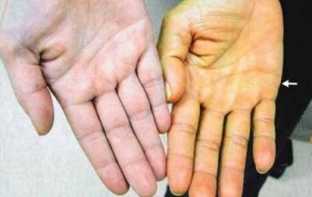 Cục Y tế dự phòng cảnh báo dịch sốt vàng đang hoành hành tại 42 quốc gia