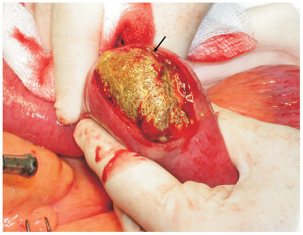 B&atilde; thức ăn kết d&iacute;nh lại g&acirc;y tắc ruột cấp t&iacute;nh phải phẫu thuật. Ảnh: Sức khỏe đời sống.