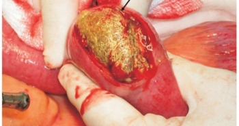 Coi chừng tắc ruột do bã thức ăn