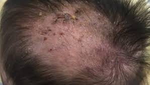 Thận trọng khi trẻ chốc đầu dai dẳng