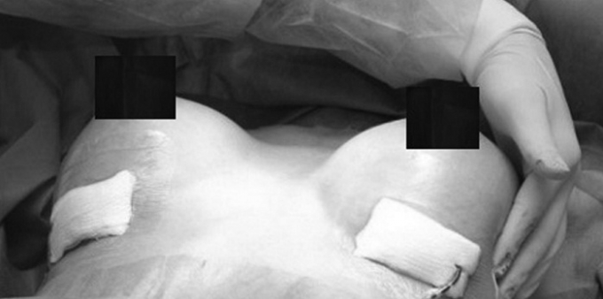 Su&yacute;t mất mạng v&igrave; tin lời tr&ugrave;m ma t&uacute;y đi n&acirc;ng ngực. (Ảnh minh họa)