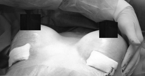 Kinh dị thủ đoạn buôn ma túy bằng cách phẫu thuật nhét vào ngực phụ nữ