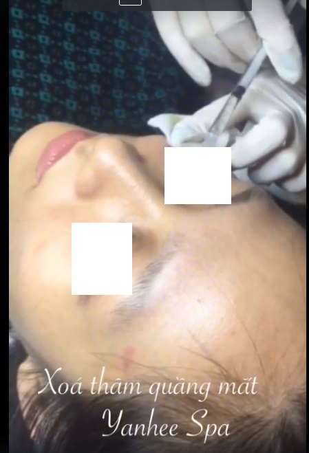 Một cảnh ti&ecirc;m x&oacute;a th&acirc;m quầng mắt được quảng c&aacute;o