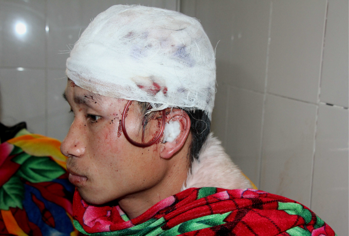 Nạn nh&acirc;n bị gấu tấn c&ocirc;ng v&agrave;o v&ugrave;ng đầu, vết thương rất nặng.