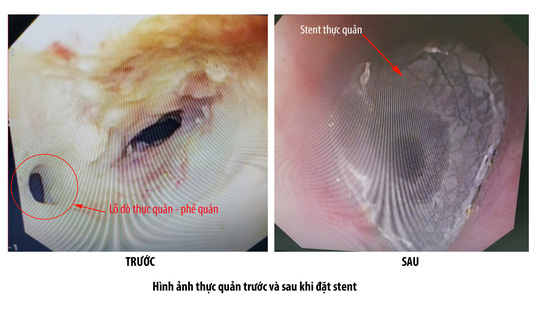 H&igrave;nh ảnh trước v&agrave; sau khi đặt stent thực quản cho bệnh nh&acirc;n B. Ảnh:&nbsp;PHƯƠNG CHI