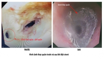 Bệnh nhân suýt chết vì mắc phải căn bệnh hiếm gặp ngày giáp Tết