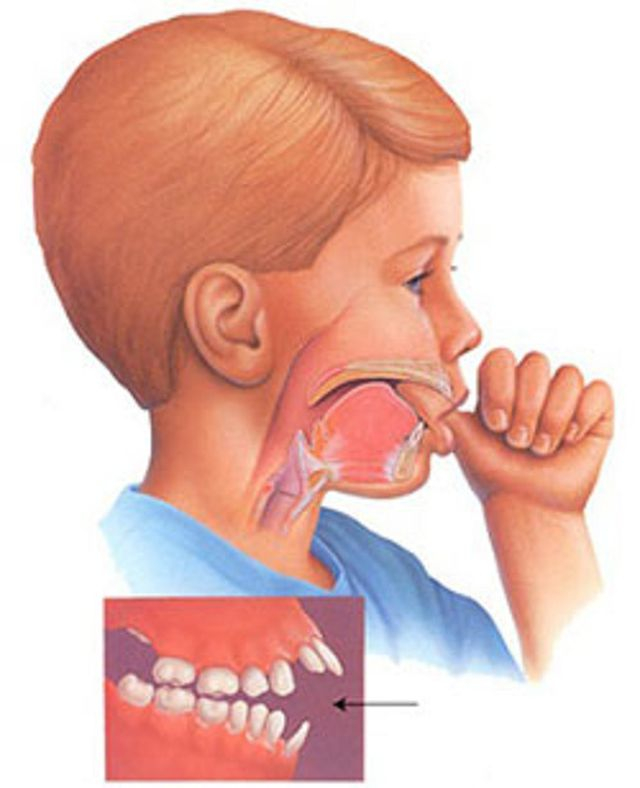 Ngậm m&uacute;t tay g&acirc;y nhiều bất lợi cho sức khỏe v&agrave; sự ph&aacute;t triển của trẻ.&nbsp;