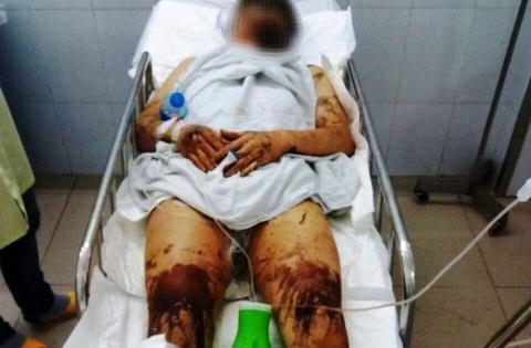 Vụ cắt gân, tạt axit ở Quảng Ngãi: "Thấy chân đau quá, nhìn xuống mới biết chân bị cắt gân"
