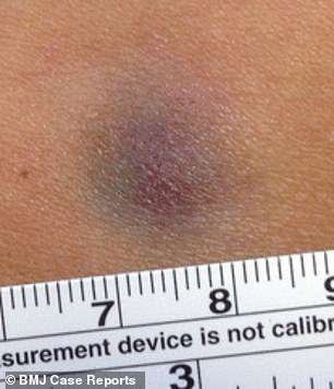 Vết bầm 1 cm k&eacute;o d&agrave;i suốt 6 năm h&oacute;a ra l&agrave; 1 căn bệnh ung thư hiếm gặp
