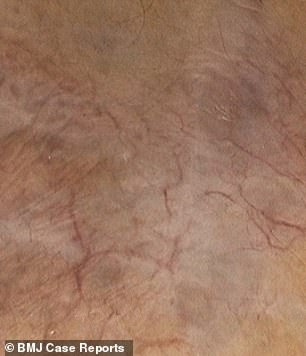 Vết bầm 1 cm k&eacute;o d&agrave;i suốt 6 năm h&oacute;a ra l&agrave; 1 căn bệnh ung thư hiếm gặp