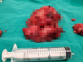 Khối u đ&atilde; được cắt bỏ.&nbsp;