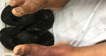 Phát hiện bị đái tháo đường nhờ… dép kẹp