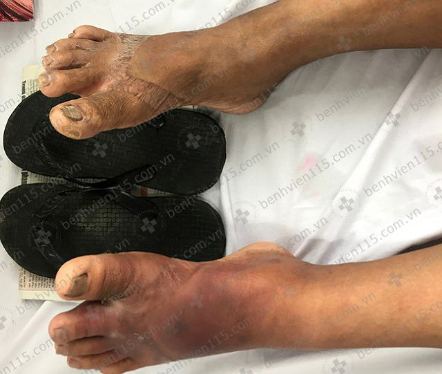 Ph&aacute;t hiện bị đ&aacute;i th&aacute;o đường nhờ&hellip; d&eacute;p kẹp