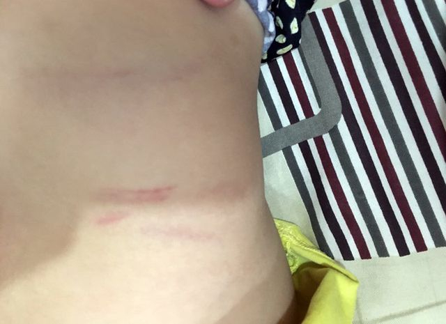 H&igrave;nh ảnh ch&aacute;u P. bị c&ocirc; đ&aacute;nh th&acirc;m bầm, trầy xước (ảnh do gia đ&igrave;nh cung cấp)