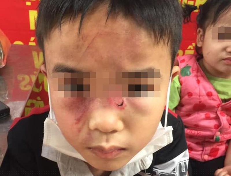 Thương tích trên mặt bé trai.