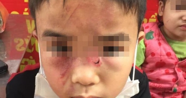 Hà Nội: Nghi vấn bé trai bị bố đẻ bạo hành dã man vì ăn trộm tiền