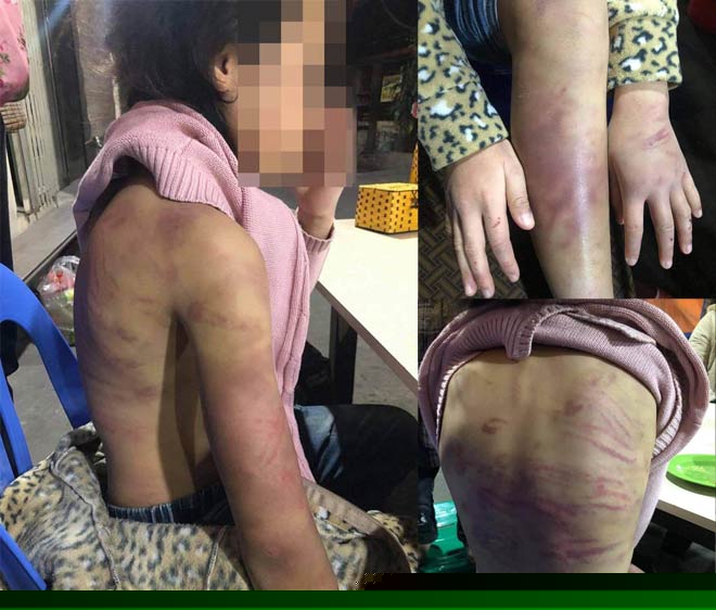 N.H.B bị mẹ bạo hành bầm tím người.