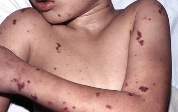 Hà Nội: Phát hiện ca nhiễm não mô cầu đầu tiên nhập viện