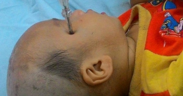 Bình Thuận: Cứu sống bé trai bị tuốc nơ vít đâm vào đầu
