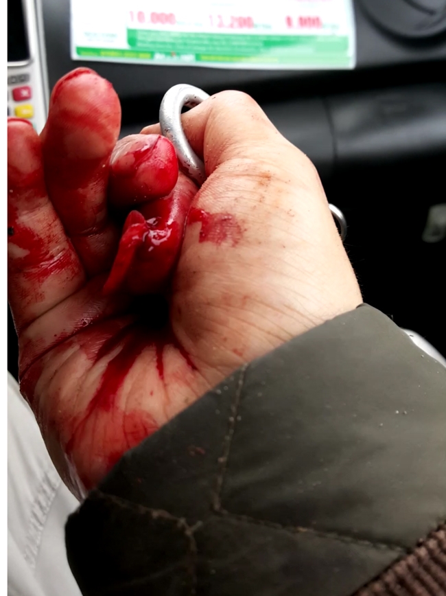 Ngo&agrave;i việc bị đ&aacute;nh bầm dập ở tay, anh Ho&agrave;ng c&ograve;n bị nhiều chỗ kh&aacute;c nữa. &nbsp;