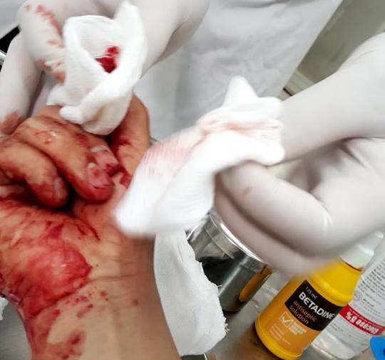 Vết thương ở b&agrave;n tay phải của nh&agrave; b&aacute;o Đỗ Do&atilde;n Ho&agrave;ng.