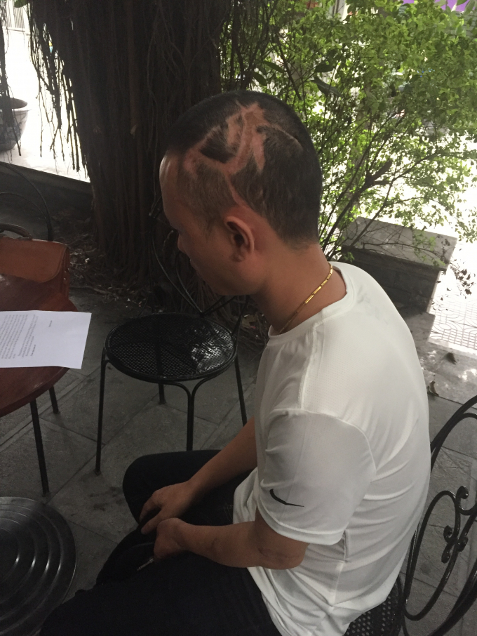 Bị hại Ph&ugrave;ng Văn Duy với nhiều vết ch&eacute;m tr&ecirc;n đầu.