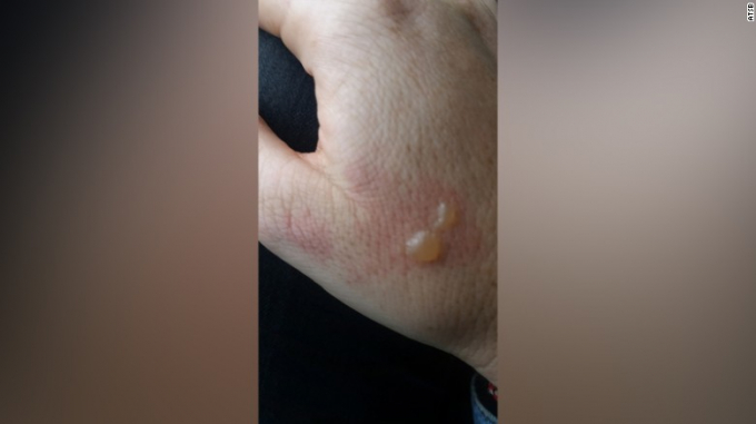 Tay nữ h&agrave;nh kh&aacute;ch bị bỏng rộp sau vụ tai nạn. (Ảnh: ATSB)