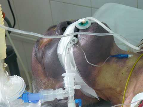 Tại biệnh viện Nhiệt đới Trung ương, từng cấp cứu nhiều ca nhiễm khuẩn li&ecirc;n cầu lợn v&agrave; tỉ lệ tử vong kh&aacute; cao. (Ảnh: VTC)