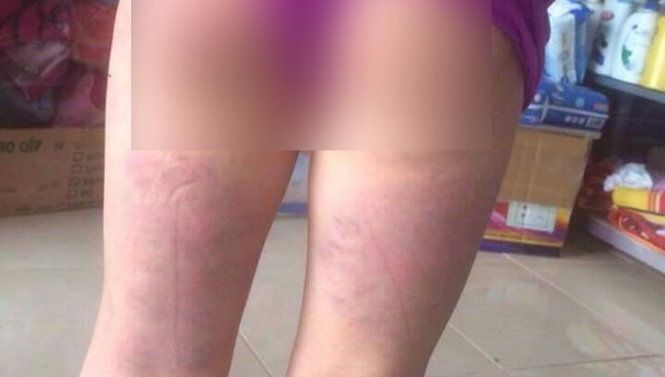 Vết thương bầm t&iacute;m ở v&ugrave;ng m&ocirc;ng đến ng&oacute;t ch&acirc;n của M. sau khi bị c&ocirc; gi&aacute;o d&ugrave;ng thước đ&aacute;nh. (Ảnh: Trung Nguyễn/Tuổi trẻ)