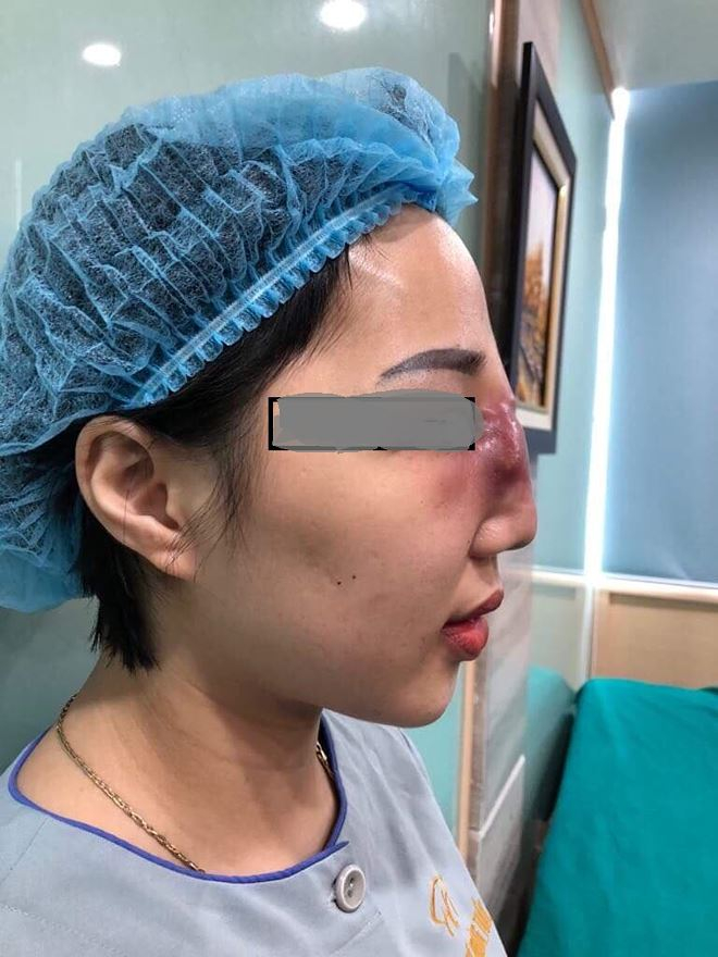 Nguy cơ hoại tử mũi v&igrave; ti&ecirc;m filler tại spa