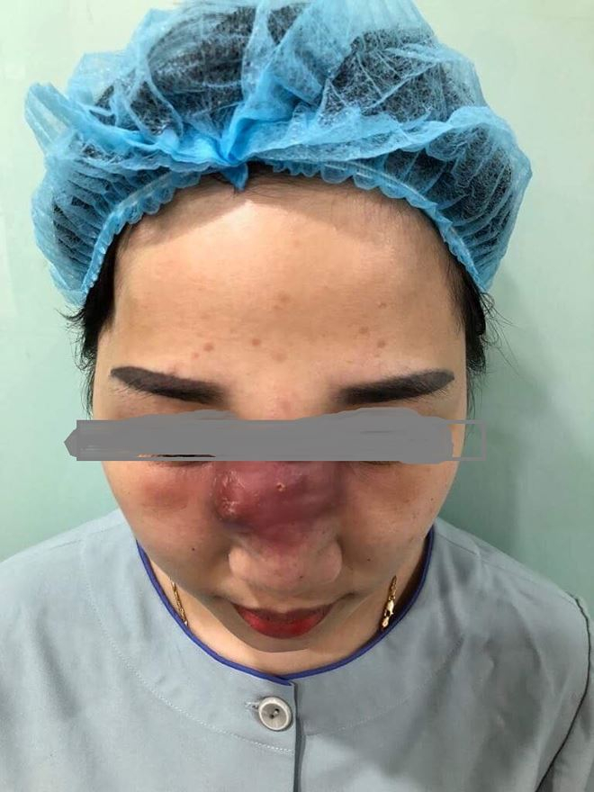 Mũi của nữ bệnh nh&acirc;n c&oacute; dấu hiệu mưng mủ, hoại tử