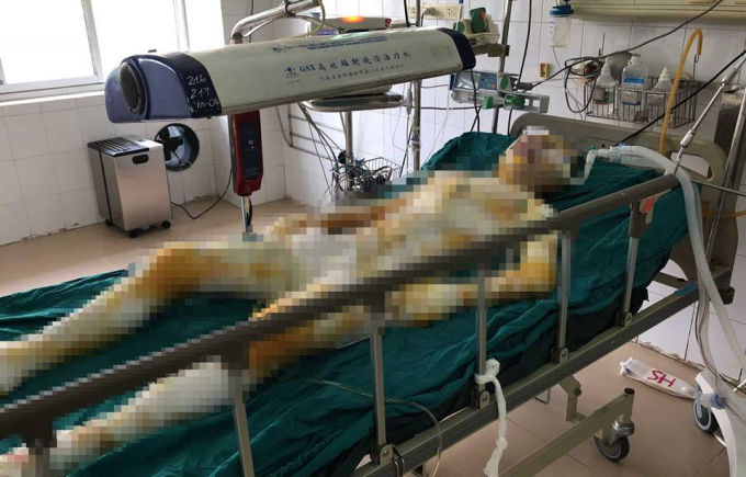 Chị H. đang điều trị tại Viện Bỏng quốc gia trong t&igrave;nh trạng&nbsp;bỏng to&agrave;n th&acirc;n 92%. (Ảnh: b&aacute;o Vietnamnet)