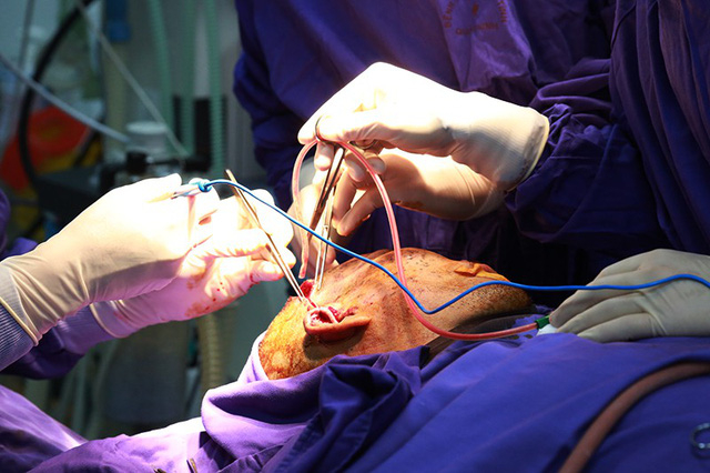 ​Tr&ecirc;n 80% dị vật ra khỏi v&ugrave;ng h&agrave;m mặt.