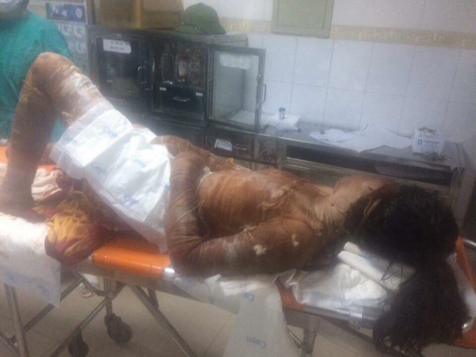 Mức độ bỏng của chị M. l&agrave; 65% cơ thể.