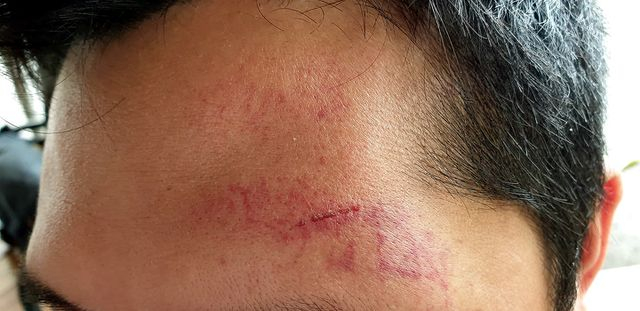 Vết thương tr&ecirc;n phần đầu anh T. do nh&oacute;m người lạ mặt g&acirc;y ra.