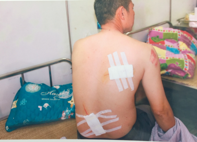 Những vết ch&eacute;m sau lưng của nạn nh&acirc;n Dũng.