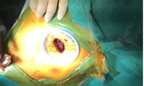 Phẫu thuật cắt u phổi một lỗ &iacute;t x&acirc;m lấn. Ảnh:&nbsp;Bệnh viện cung cấp.