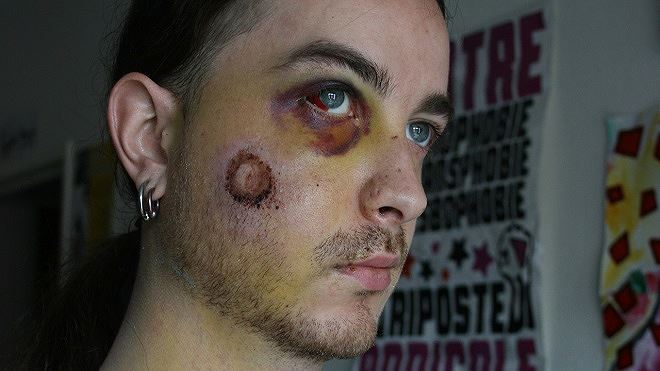 &nbsp;Dấu t&iacute;ch do s&uacute;ng LBD g&acirc;y ra.