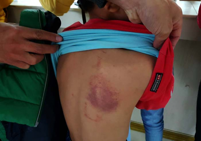 Vết t&iacute;m ở lưng do c&ocirc; gi&aacute;o Chủ nhiệm d&ugrave;ng thước kẻ đ&aacute;nh em Ph&uacute;.