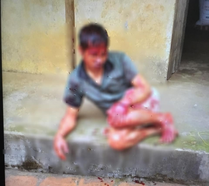 Anh D. bị h&agrave;ng x&oacute;m ch&eacute;m trọng thương.