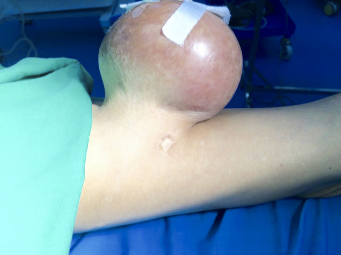 Khối u khổng lồ đeo b&aacute;m tr&ecirc;n cơ thể nam bệnh nh&acirc;n trong suốt 12 năm qua.