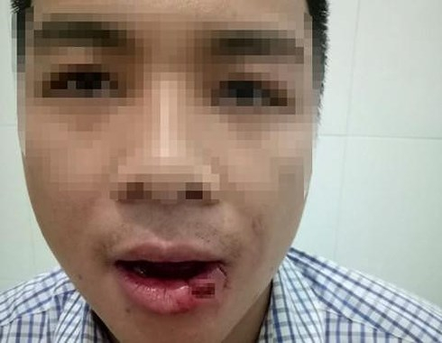 Nh&acirc;n vi&ecirc;n t&ograve;a bị thầy gi&aacute;o n&eacute;m thanh sắt g&atilde;y 5 răng.