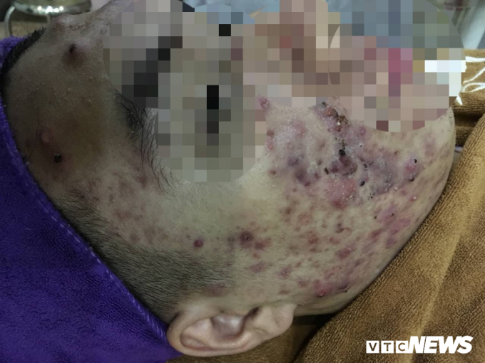 Khu&ocirc;n mặt biến chứng nghi&ecirc;m trọng của một người lăn kim l&agrave;m đẹp tại cơ sở kh&ocirc;ng đảm bảo. (Ảnh: Phạm Qu&yacute;)