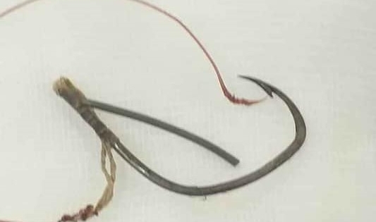 Người đàn ông được đưa đến bệnh viện với chiếc lưỡi câu móc thẳng vào mắt