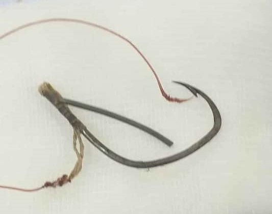 Người đàn ông được đưa đến bệnh viện với chiếc lưỡi câu móc thẳng vào mắt