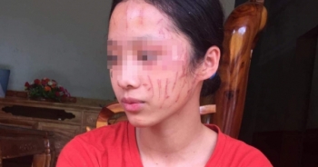 Ám ảnh khuôn mặt nữ sinh lớp 8 bị bạn cào xước