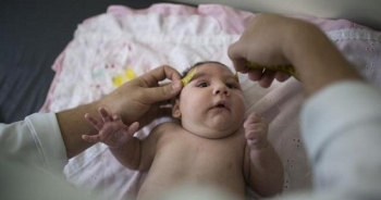 "Mối quan hệ tay ba" giữa virus Zika, chứng đầu nhỏ và hội chứng Guillain-Barré