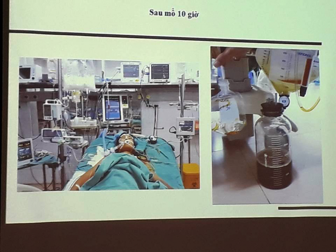 H&igrave;nh ảnh bệnh nh&acirc;n hồi phục sau gh&eacute;p gan (Ảnh: BSCC).