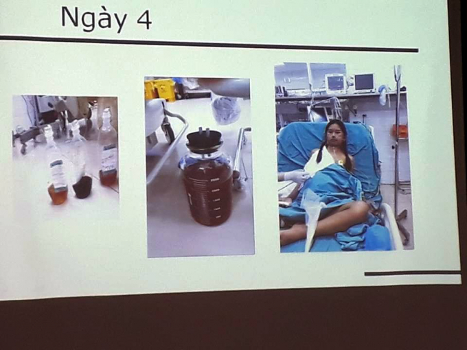 B&eacute; Mai ngồi dậy được v&agrave; n&oacute;i chuyện vui vẻ với c&aacute;c BS sau gh&eacute;p ng&agrave;y thứ 4 (Ảnh: BSCC).