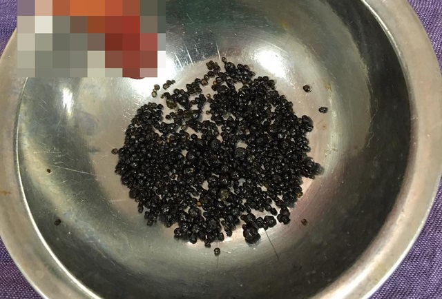 H&agrave;ng trăm vi&ecirc;n sỏi được lấy ra từ t&uacute;i mật của nữ bệnh nh&acirc;n.